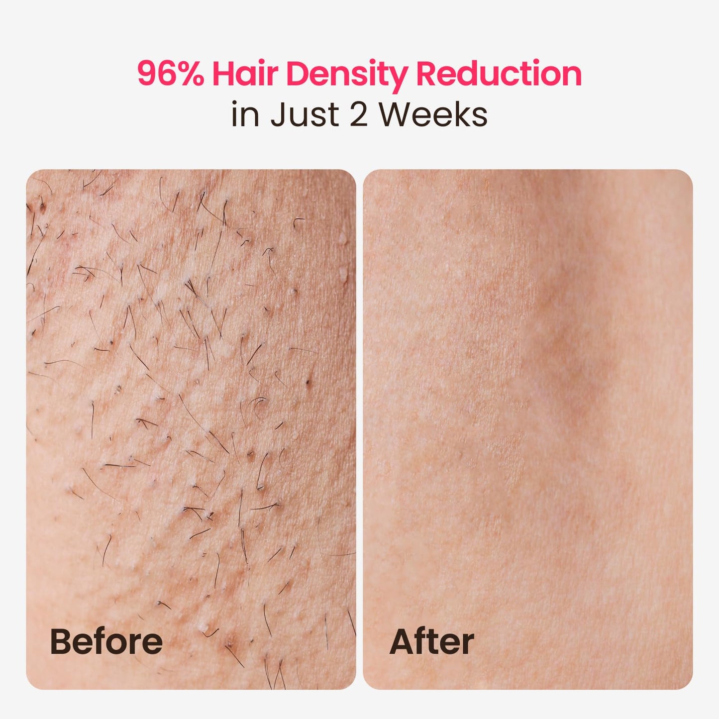 Laser Hair Removal, 25J Energy Triple-Pulse IPL Laser Hair Removal for Women, 12 cm² Comfort Sapphire 37 °F Ice-Cooling Contact, Hair Removal Device for Armpits Legs Arms Bikini Line