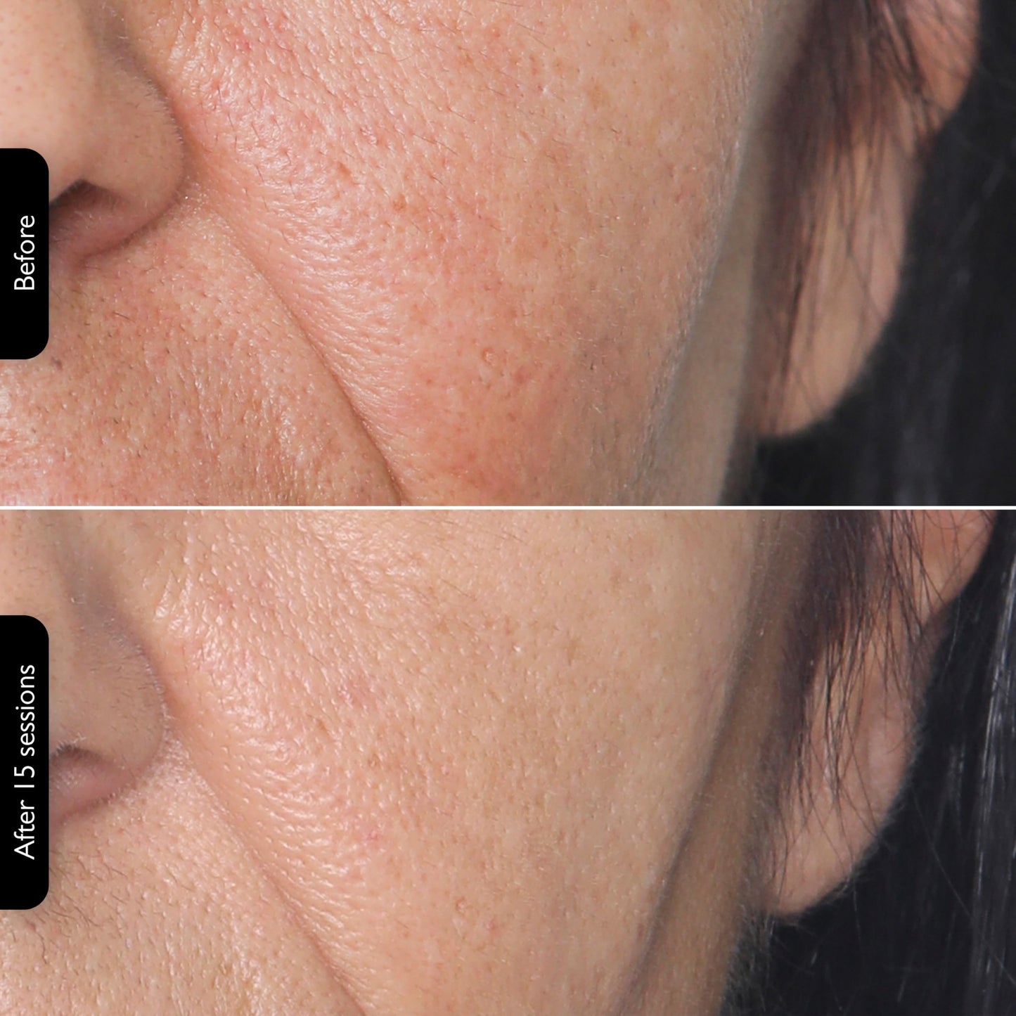 Silk’n Titan Multiplatform At-Home 3-in-1 Radio Frequency Skin Tightening Device for Face and Neck, Combines RF with Low-Level Laser Therapy & Red Light Therapy, with Thermal Sensor, Cordless