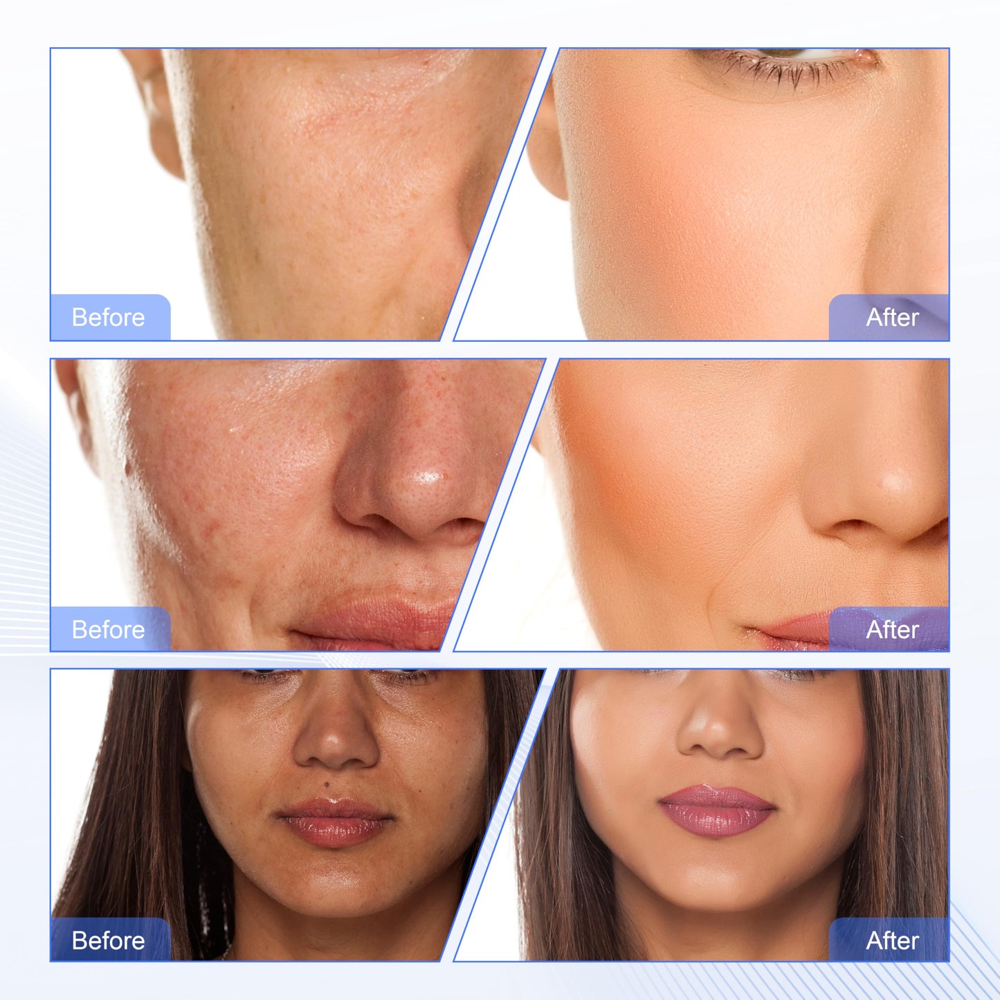 Facial Dermabrasion Machine Dermabrasion Skin Peel Water Machine (ETWD007)