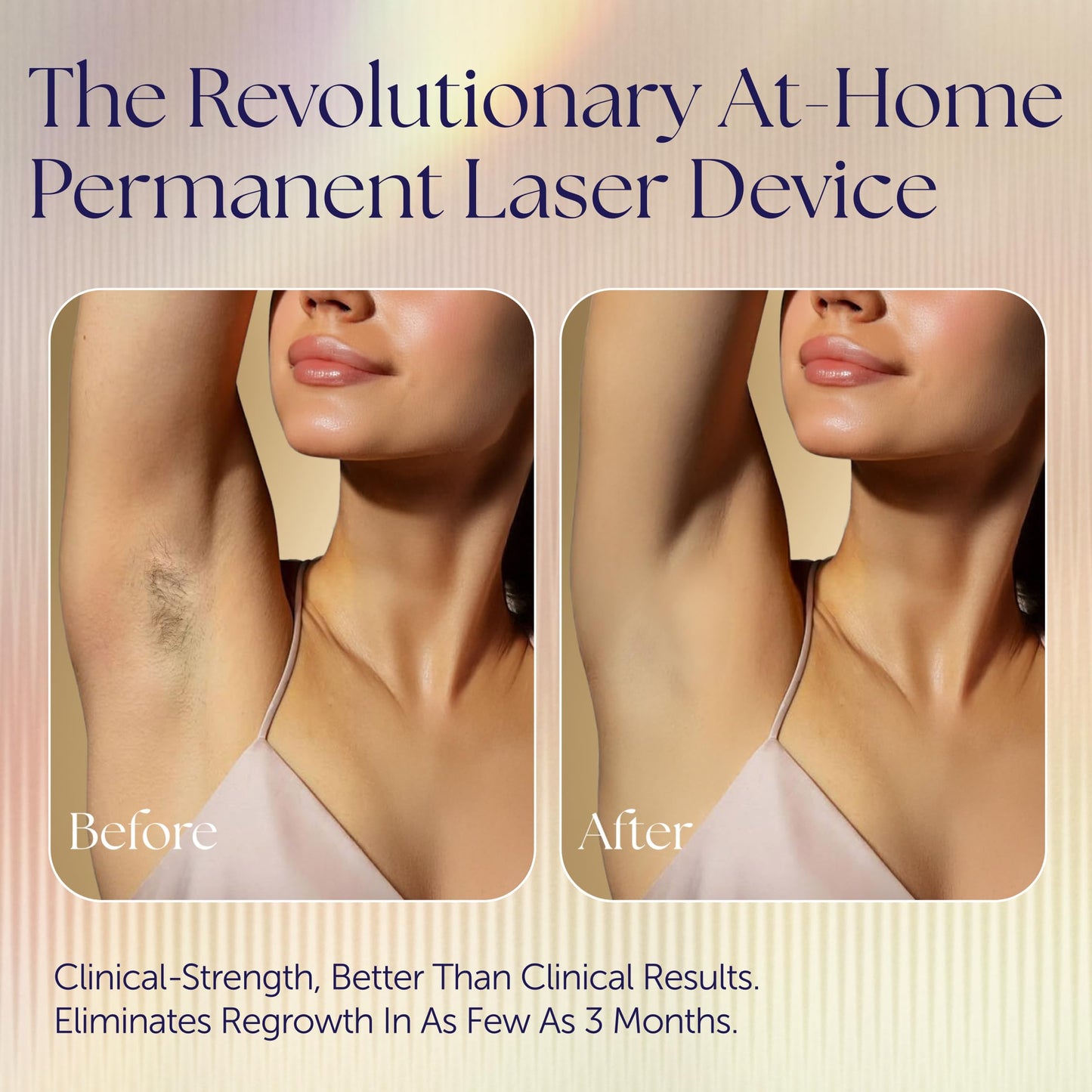 Epilaser At-Home True Laser Hair Removal Device for Light Skin, Safe, Intelligent, Painless and Permanent Hair Removal for Face, Body, Bikini Line