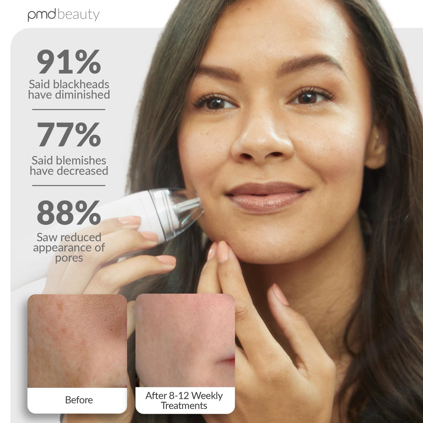 PMD Personal Microderm Pro - At-Home Microdermabrasion Machine with Kit for Face & Body - Exfoliating Crystals and Vacuum Suction for Fresh and Radiant Skin - High & Low Speed Options
