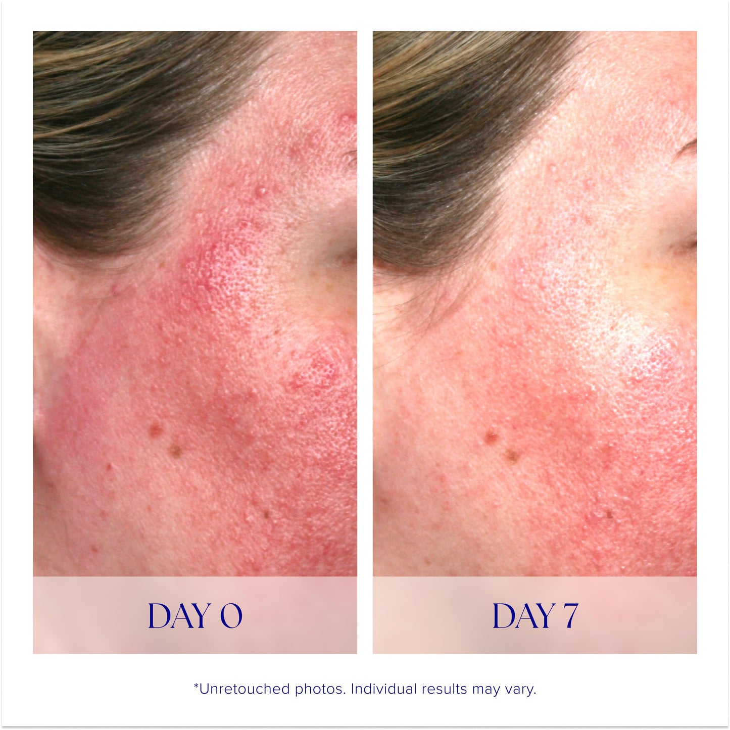 iS CLINICAL Pro-Heal Serum Advance+ Antioxidant-Rich Serum With Vitamin C, E, and A for Redness, Inflammation, Wrinkle-Smoothing, Sun Damage Repairing - 1 Fl Oz