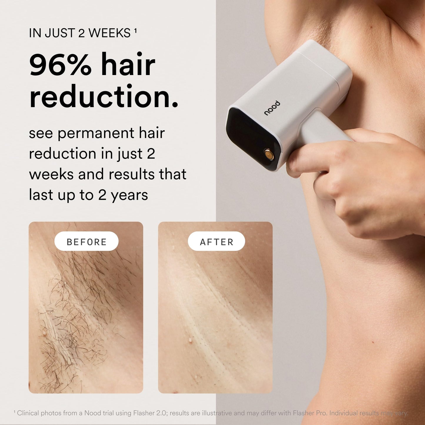 Nood™ NEW Flasher Pro + Slow-Grow Serum — IPL Laser Hair Removal Device for Women & Men + After Shave Serum to Slow Hair Regrowth While Reducing Ingrown Hair & Skin Irritation — Gloss White