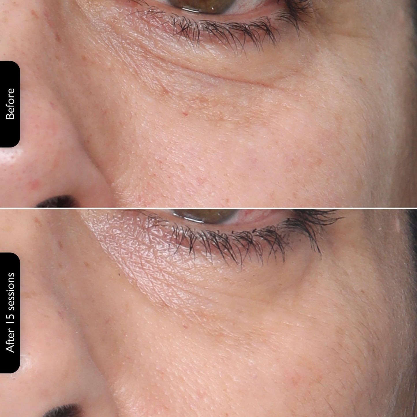 Silk’n Titan Multiplatform At-Home 3-in-1 Radio Frequency Skin Tightening Device for Face and Neck, Combines RF with Low-Level Laser Therapy & Red Light Therapy, with Thermal Sensor, Cordless