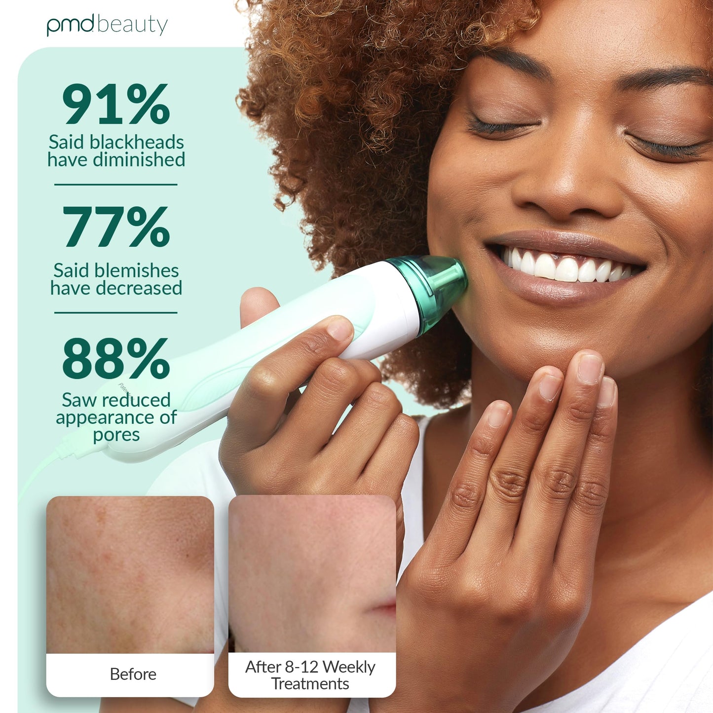 PMD Personal Microderm Pro - At-Home Microdermabrasion Machine with Kit for Face & Body - Exfoliating Crystals and Vacuum Suction for Fresh and Radiant Skin - High & Low Speed Options
