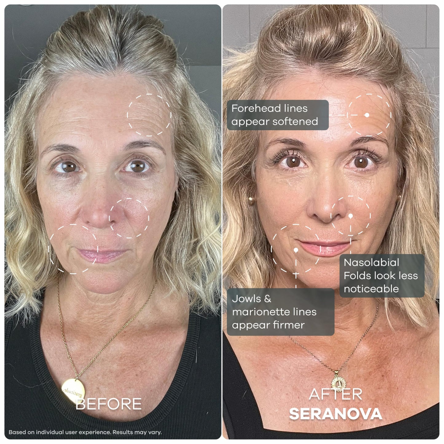 Seranova Micro Infusion System for Face & Neck 0.05mm Stamp with Hyaluronic Acid & Collagen Peptide Serum for Firmer Smoother-Looking Skin, Easy 5-Minute At-Home Skin Care Application - 2 Month Supply